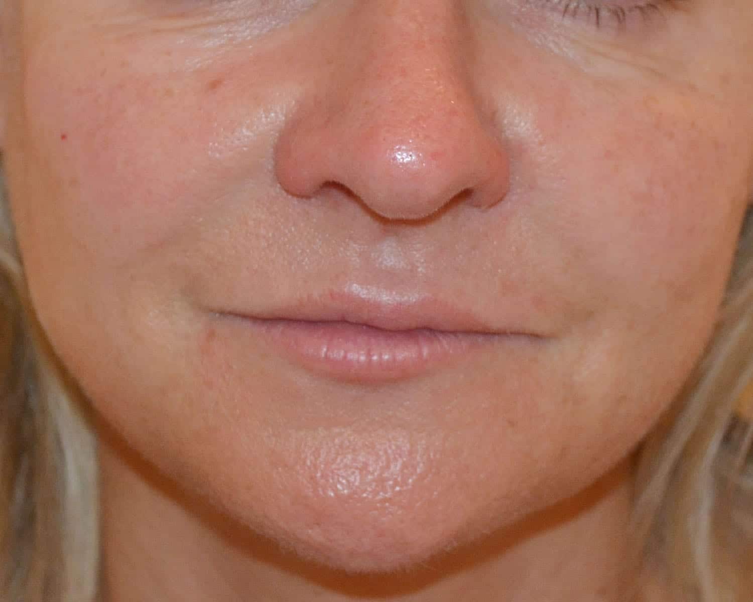 Cheek Filler After