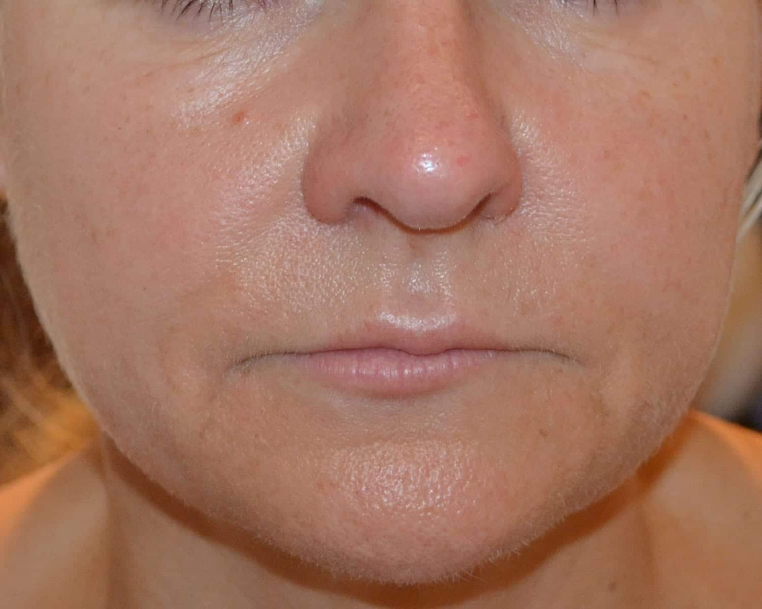 Cheek Filler Before