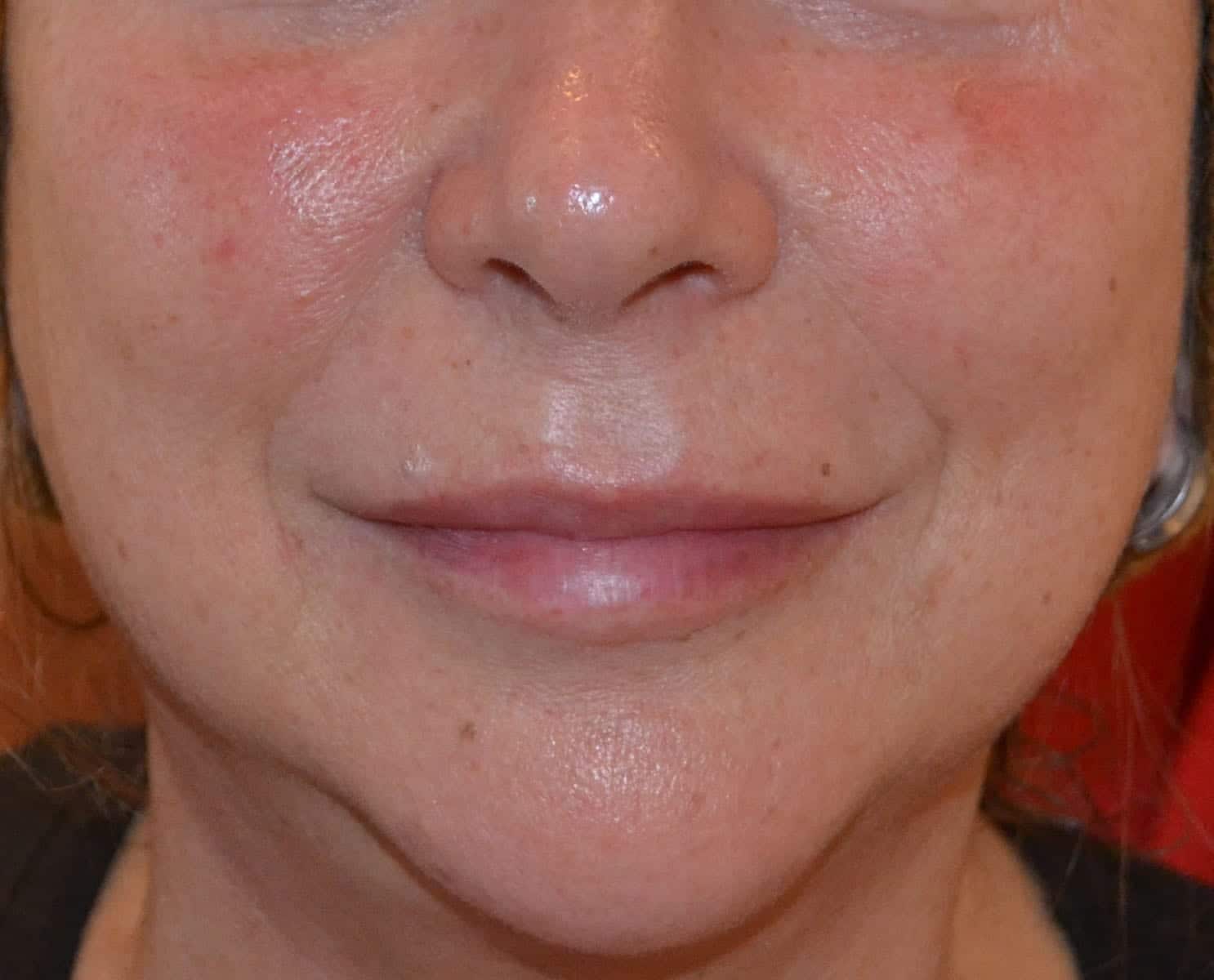 Liquid Facelift After