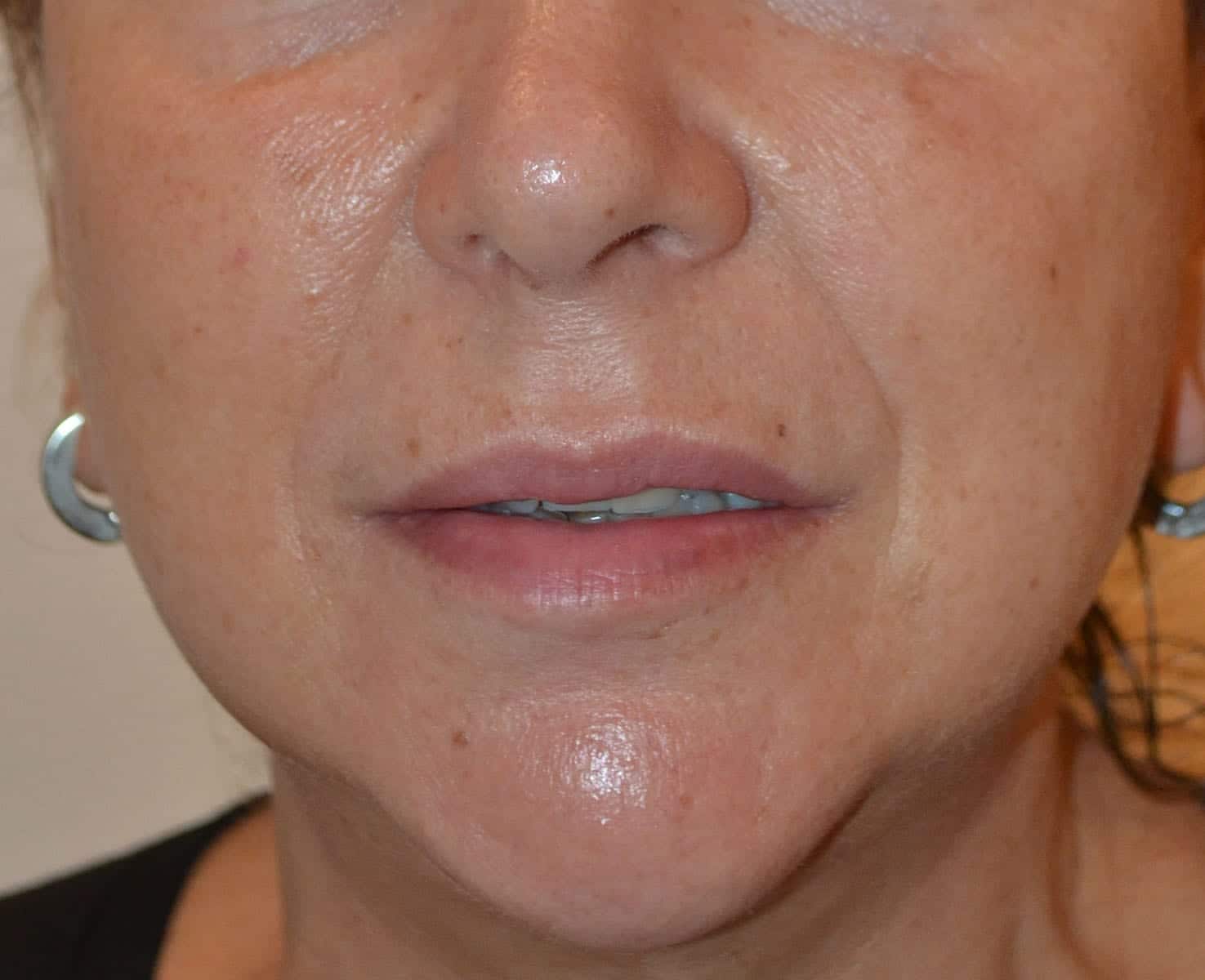 Liquid Facelift Before