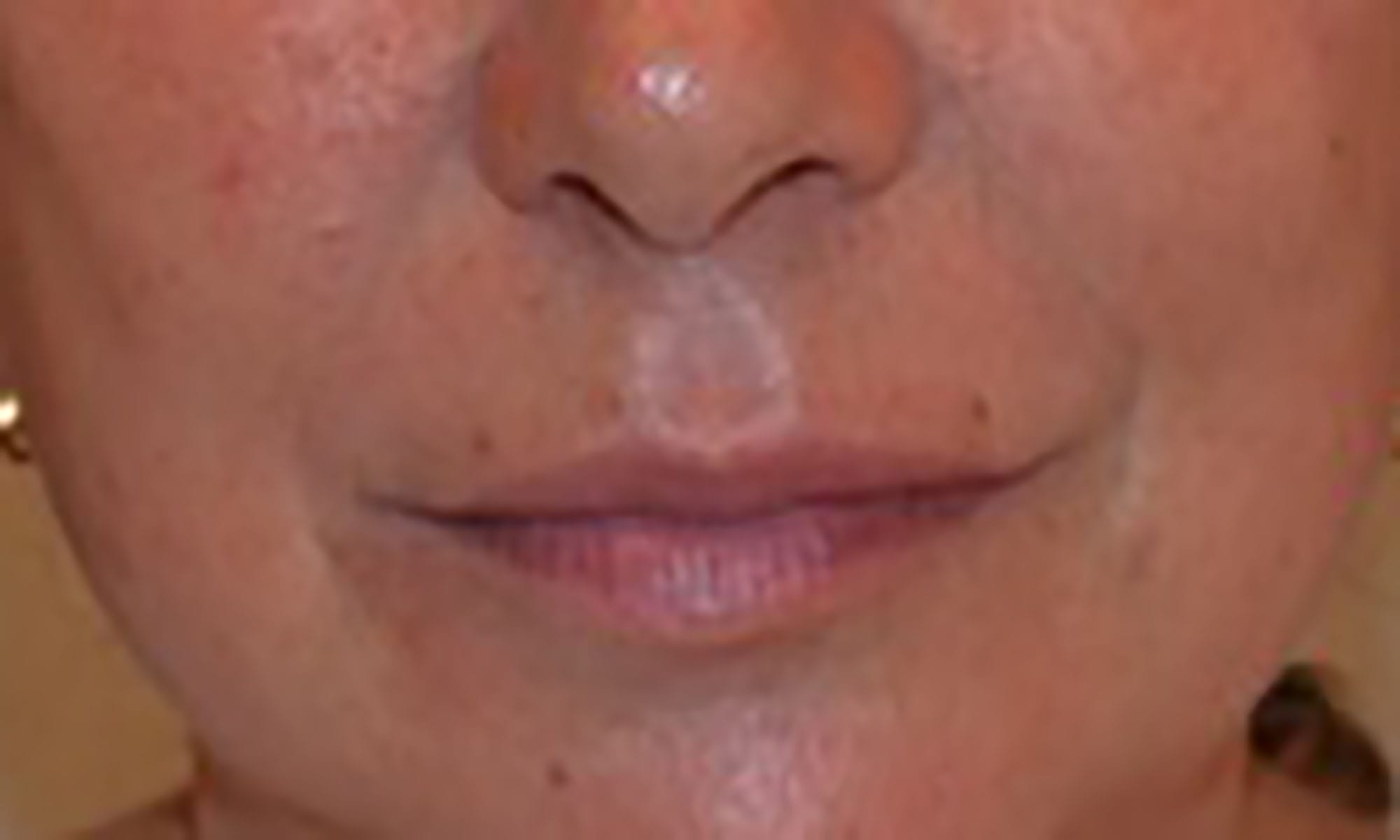 Dermal Filler Wrinkle After