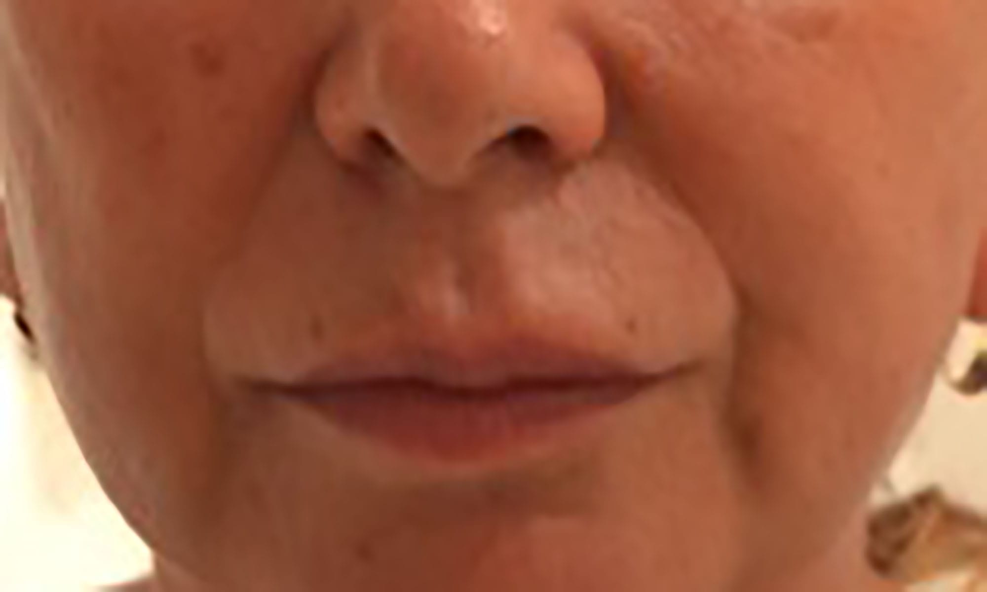 Dermal Filler Wrinkle Before
