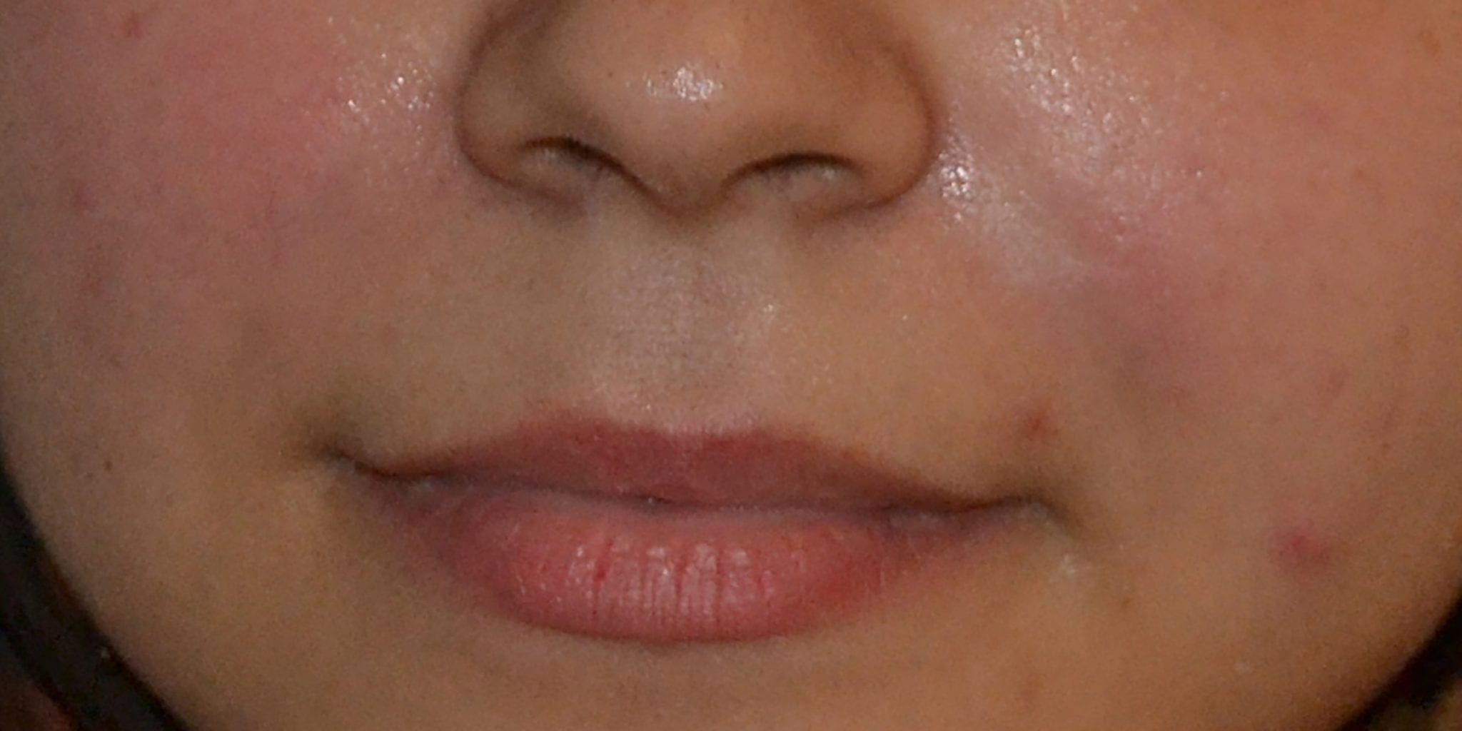 Dermal Filler Wrinkle After