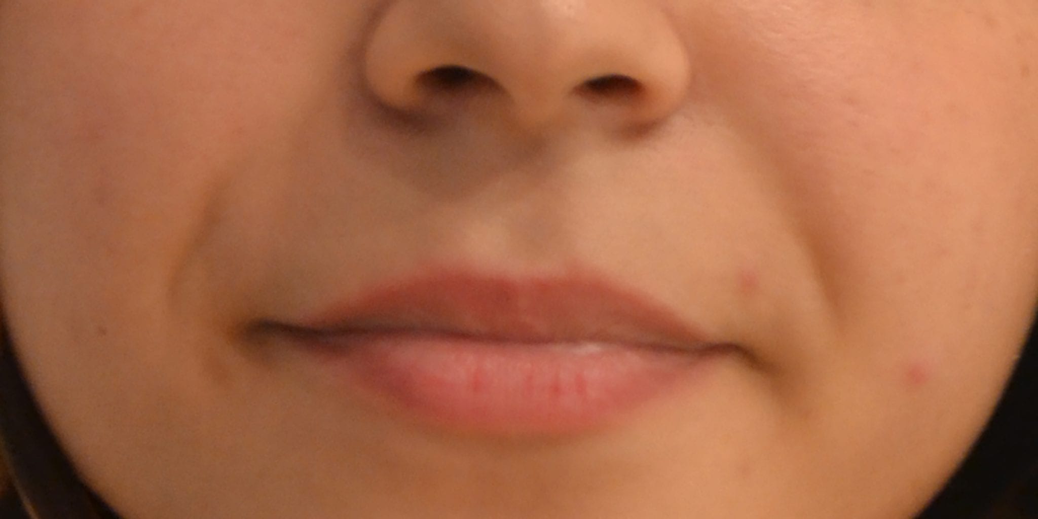 Dermal Filler Wrinkle Before