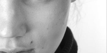 Under Eye Circles, Bags & Tear Troughs