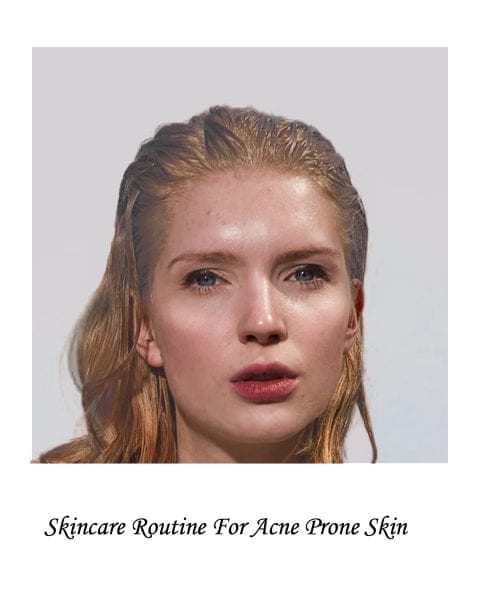 Image of model for acne prone skin skincare routine