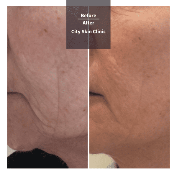Before and after images for Profhilo treatment in London