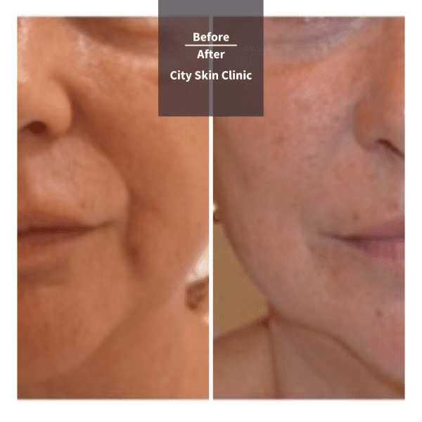 Before and after images for dermal fillers in London