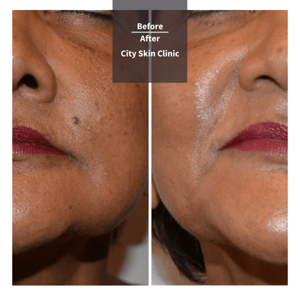Before and after images for Profhilo treatment in London
