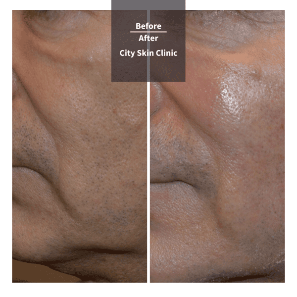 Before and after images for dermal fillers in London