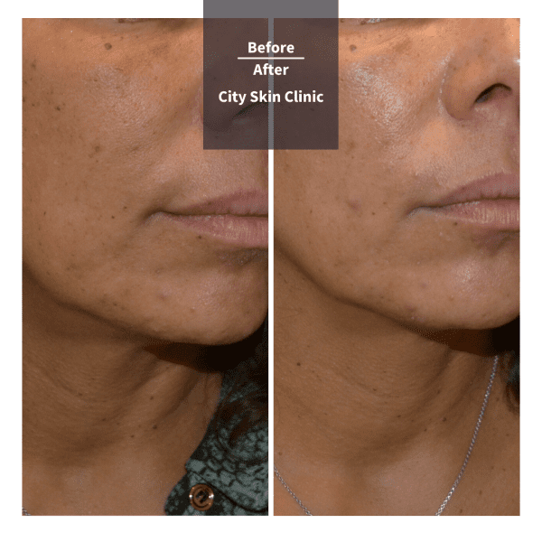 Before and after images for Profhilo treatment in London