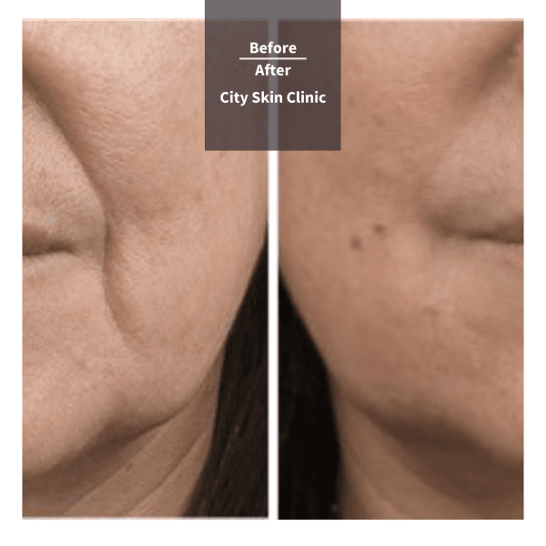 Before and after images for dermal fillers in London