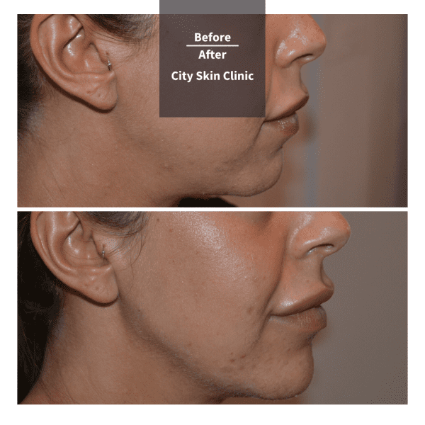 before and after images for Jawline Reshaping & Chin Enhancement with Juvederm Volux and Voluma in London