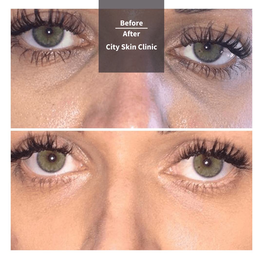 Tear Trough Fillers Under Eye Fillers Treatment in London City Skin Clinic