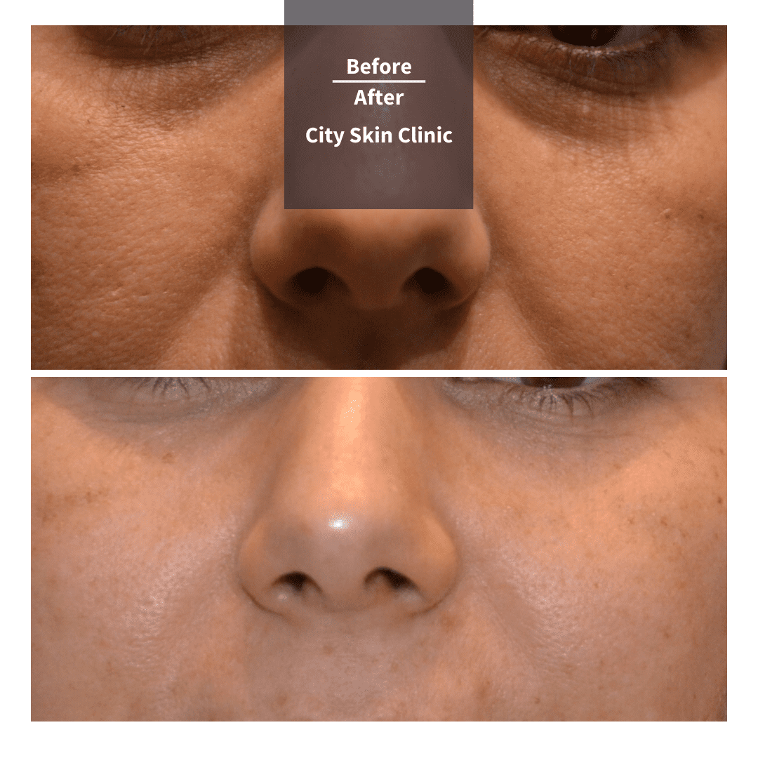 Tear Trough Fillers Under Eye Fillers Treatment in London City Skin