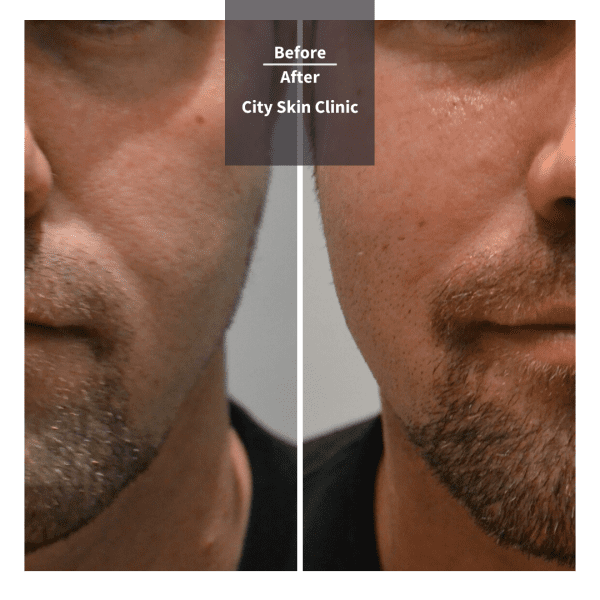 Before and after images for cheek and tear trough fillers in London