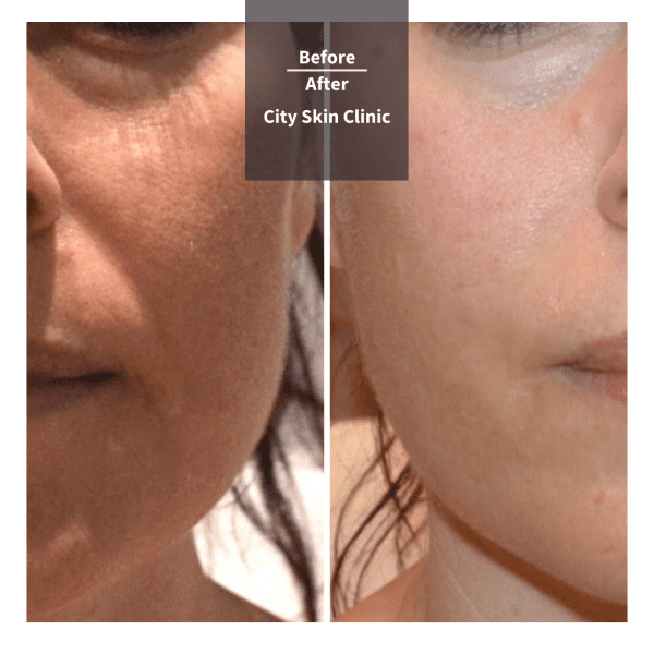 Before and after images for cheek and tear trough fillers in London