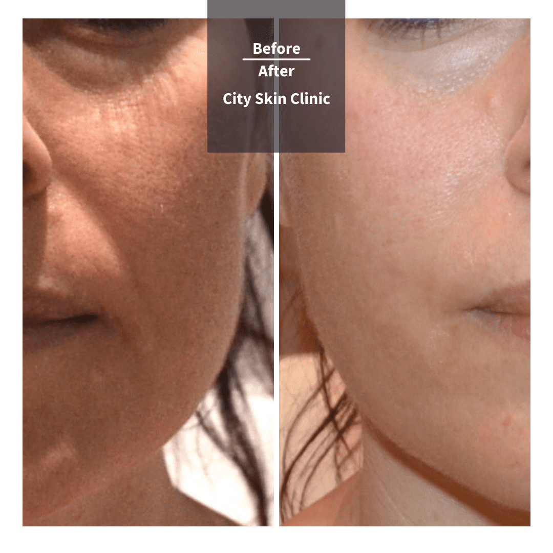 Cheek and Tear Trough Filler Treatment in London City Skin Clinic