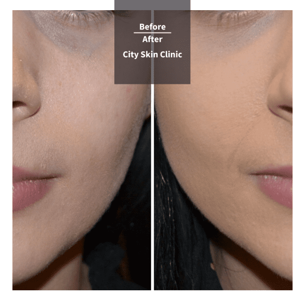 Before and after images for cheek and tear trough fillers in London