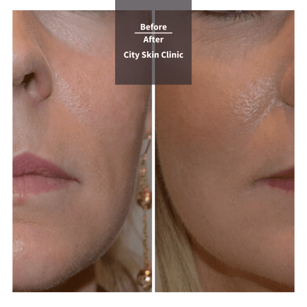 Before and after images for cheek and tear trough fillers in London