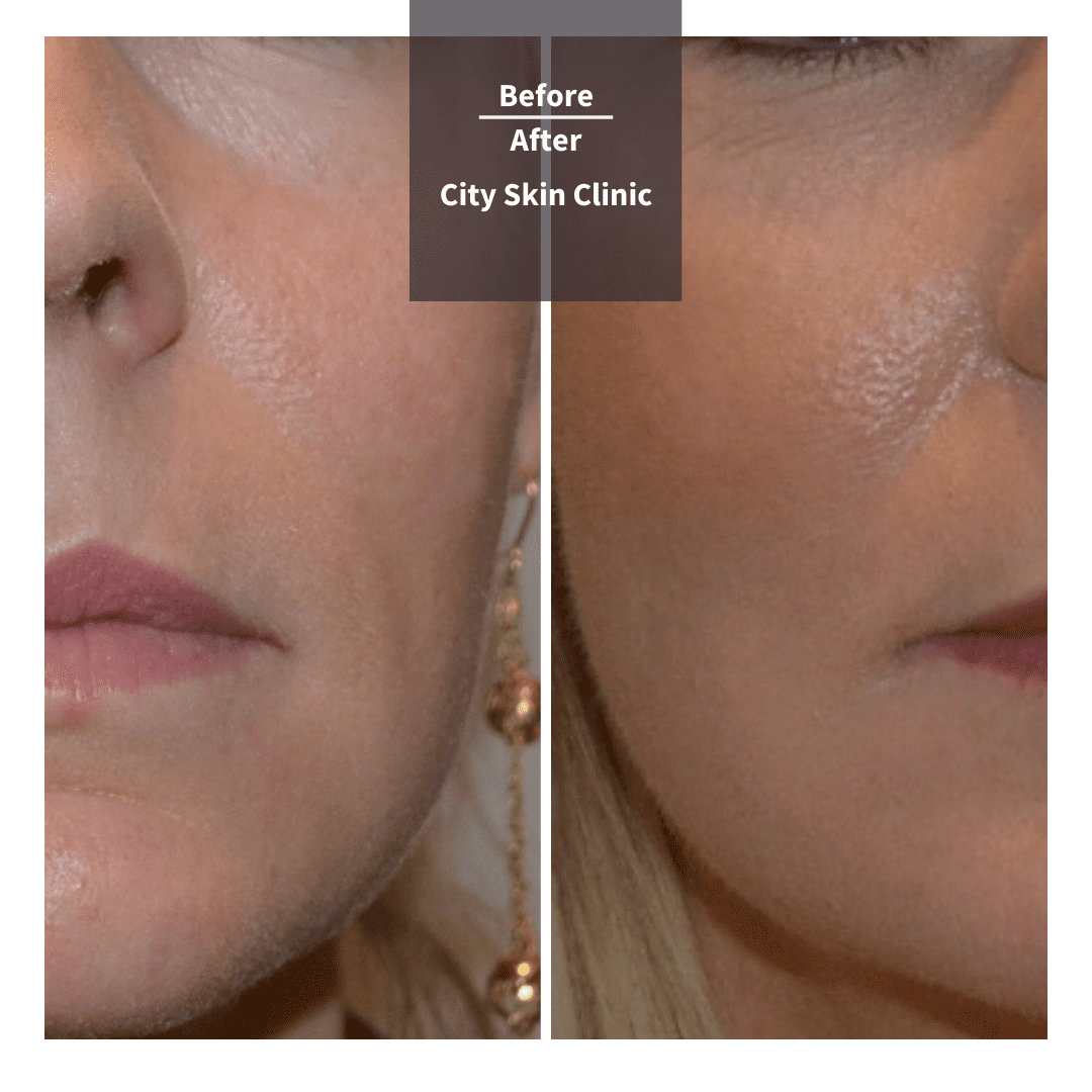 Cheek and Tear Trough Filler Treatment in London City Skin Clinic