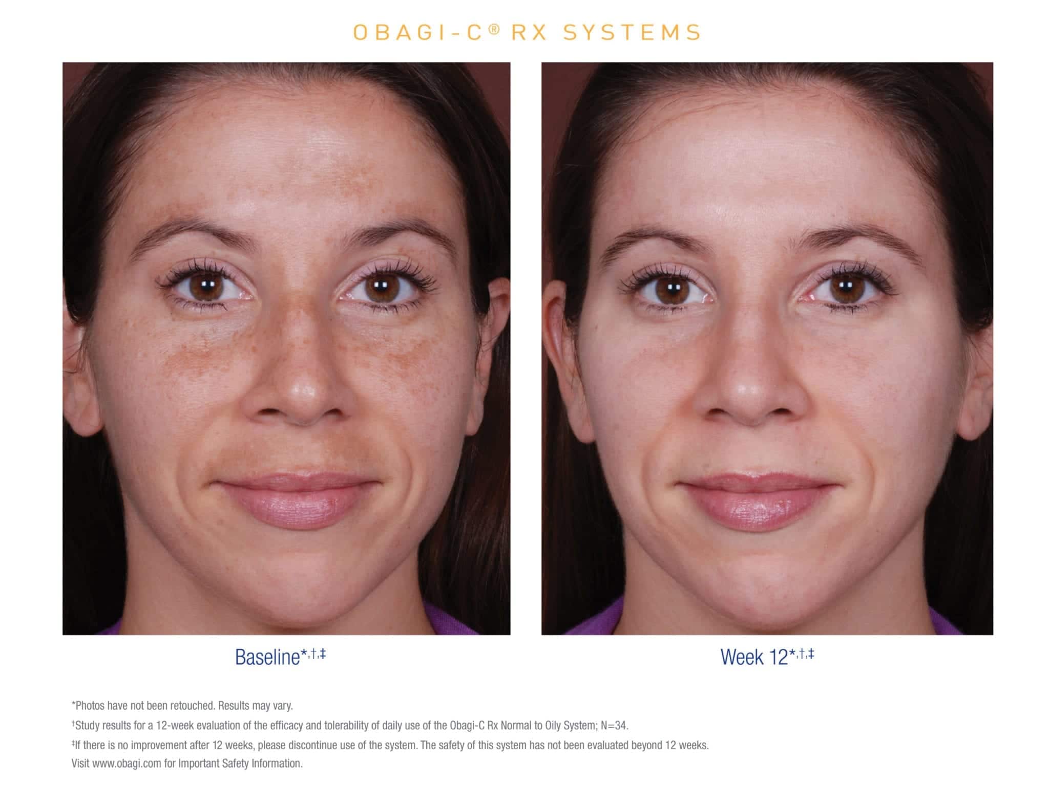 Obagi Skincare Online Shop Nu Derm, ClenziDERM, ObagiC & Tretinoin