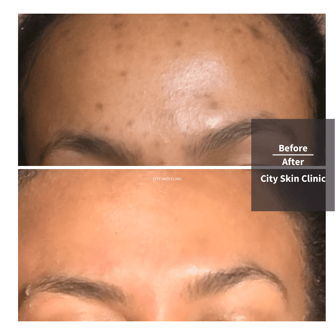 Hyperpigmentation Causes & Treatments, A Quick Guide