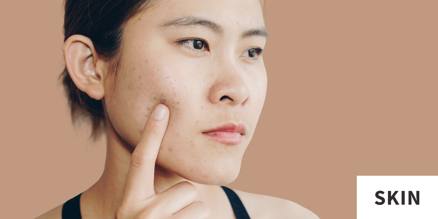 can i take glutathione while on isotretinoin Which Foods to Avoid Accutane What You Should Know About