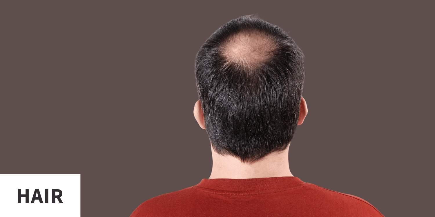 Crown Hair Loss